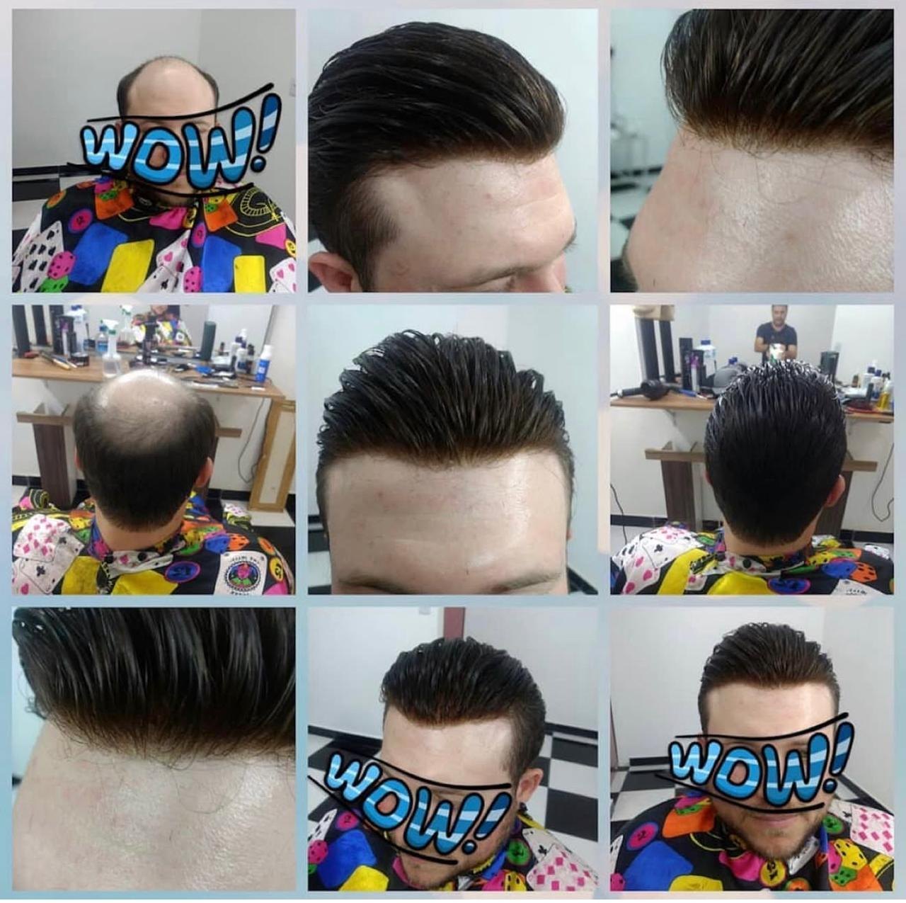 Transformação com prótese capilar masculina, com registros de antes, aplicação e resultado final