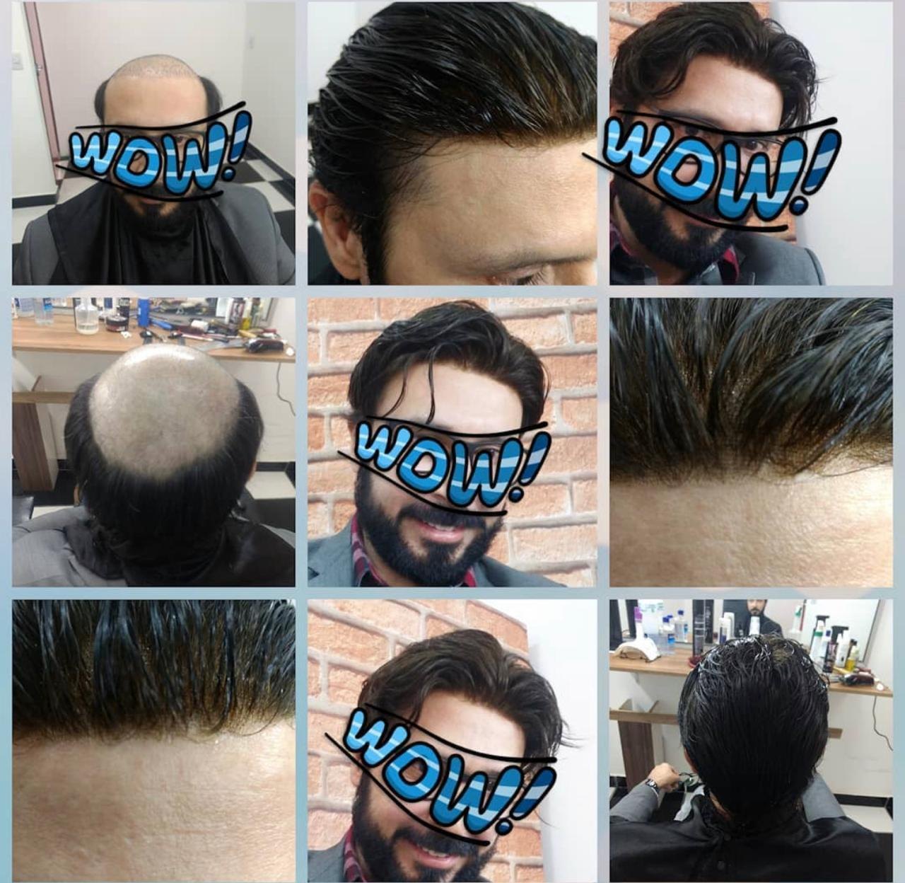 Transformação com prótese capilar masculina e acabamento frontal natural